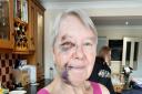 Gillian Bartram suffered a bad fall in Dereham last week, breaking the orbital bone below her eye.